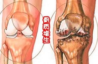 膝关节骨质增生的锻炼方法有哪些