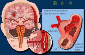 脑溢血的康复治疗方法有哪些